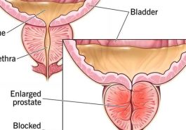 Herbs To Cure Your Prostate Problems? I Don’t Think So - DETAILS