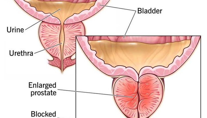 Herbs To Cure Your Prostate Problems? I Don’t Think So - DETAILS