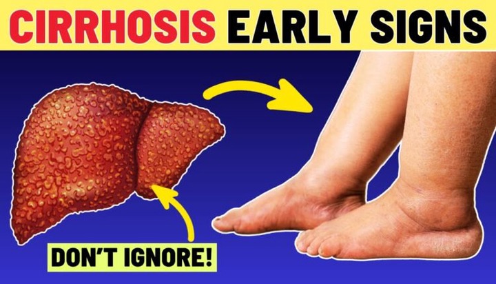 JUST-IN: Early Signs of Liver Enlargement You Should Never Ignore
