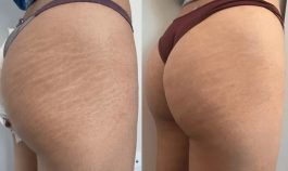 Stretch Mark Camouflage: How It Works & Why To Try It
