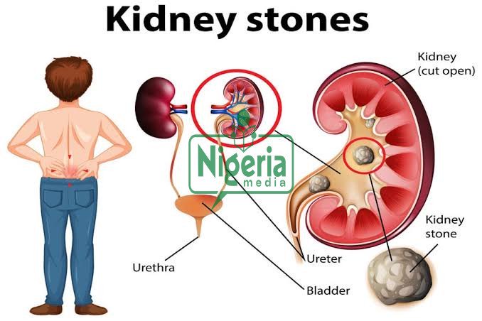 Foods You Should Stop Eating To Prevent Kidney Problems Foods You Should Stop Eating To Prevent Kidney Problems
