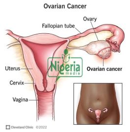 JUST IN: Causes And Signs Of Ovarian Cancer