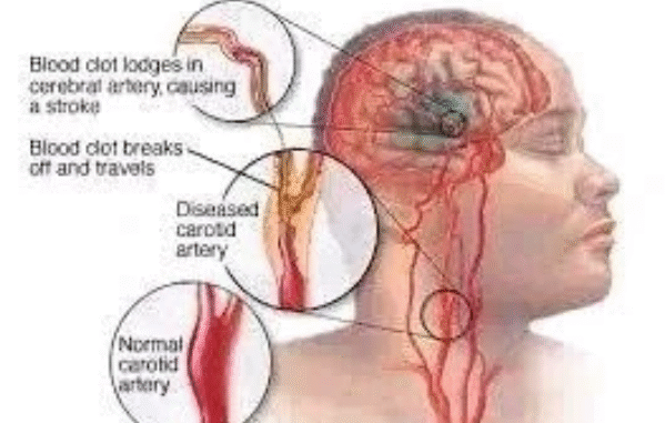 JUST IN: If You Don’t Want To Suffer Stroke At Old Age, Avoid Excess Intake Of These three Things