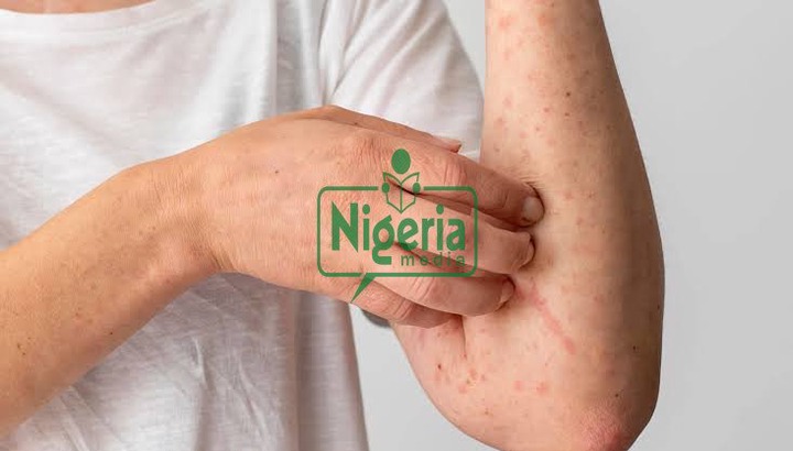 Six (6)Sign That You May Have HIV/AIDS But You Do Not Know