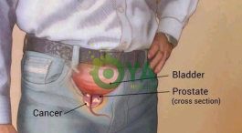 5 Early Warning Signs Of An Enlarged Prostate That Every Man Need To Know