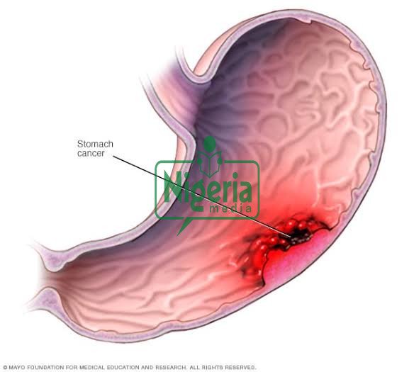 Cancer Of The Stomach Kills, Stop Eating These Three Things. If You Want To Live Long (