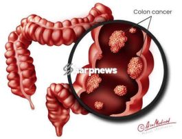 Cancer Of The Intestine Kills Fast: Avoid Too Much Intake Of These 3 Things If You Want To Live Long