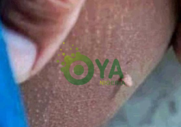 JUST-IN: What These Little Bumps On The Skin Are And How To Take Care Of Them