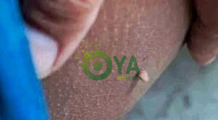 JUST-IN: What These Little Bumps On The Skin Are And How To Take Care Of Them
