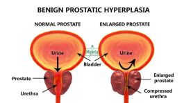 5 Early Warning Signs Of An Enlarged Prostate That Every Man Need To Know