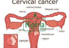 JUST-IN: Cervical Cancer Kills, Seek Medical Attention If You Notice These Signs