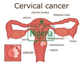 JUST-IN: Cervical Cancer Kills, Seek Medical Attention If You Notice These Signs