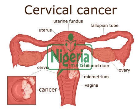 JUST-IN: Cervical Cancer Kills, Seek Medical Attention If You Notice These Signs