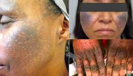 BREAKING: Skin Bleaching Creams & Pills Can Damage Your Kidney & Liver Permanently!