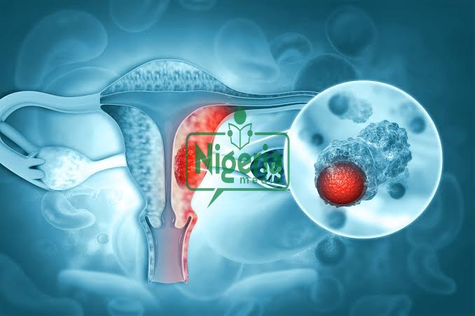 Uterine Cancer: Stay Away From These Four Things To Avoid The Risk Of Being A Victim
