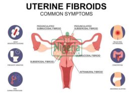 Seven 7 Signs That A Fibroid Is In Your Womb