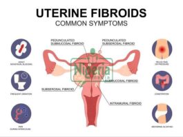 Seven 7 Signs That A Fibroid Is In Your Womb
