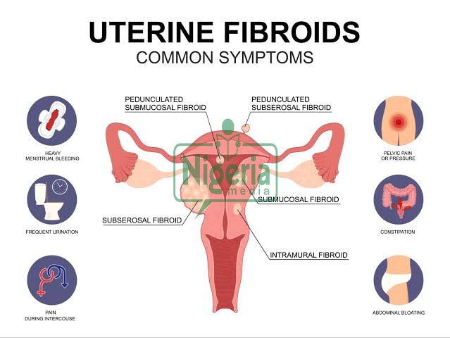 Seven 7 Signs That A Fibroid Is In Your Womb