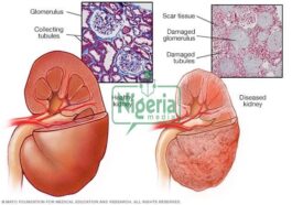 Foods to Eat When Faced with Chronic Kidney Disease (DETAILS)