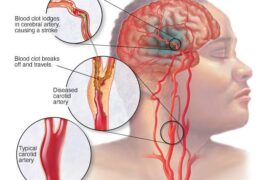 The Brain Isn’t the Only Place Strokes Occur. Four 4 Symptoms to Pay Attention