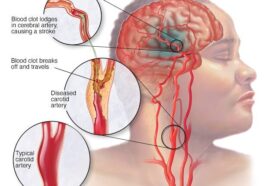 The Brain Isn’t the Only Place Strokes Occur. Four 4 Symptoms to Pay Attention