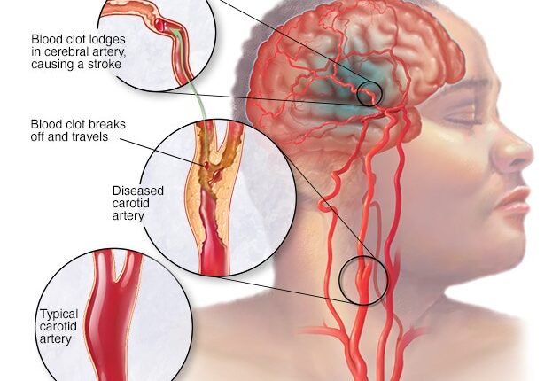 The Brain Isn’t the Only Place Strokes Occur. Four 4 Symptoms to Pay Attention The Brain Isn’t the Only Place Strokes Occur. Four 4 Symptoms to Pay Attention