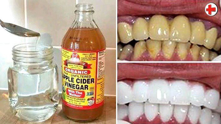 Here is what happens when you apply vinegar on your teeth