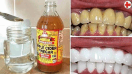 Here is what happens when you apply vinegar on your teeth