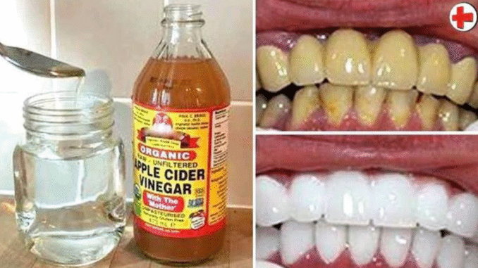 Here is what happens when you apply vinegar on your teeth