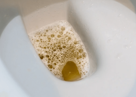 Cloudy Urine: Health Conditions That Can Make Your Urine Appear Cloudy