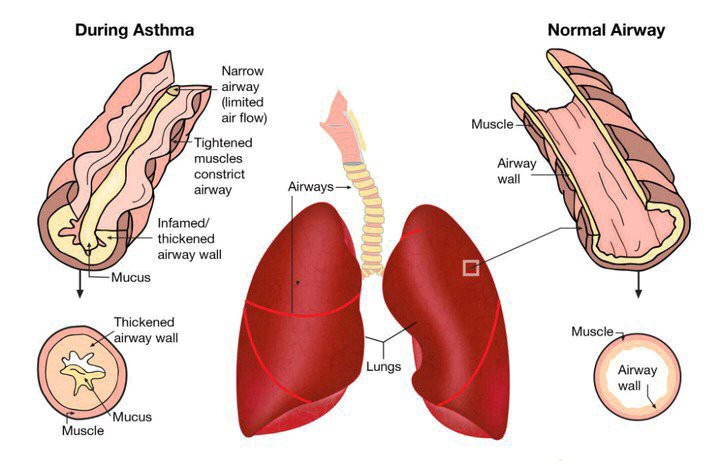 Important Traditional remedy for asthma, bronchitis, cough and lung diseases Important Traditional remedy for asthma, bronchitis, cough and lung diseases