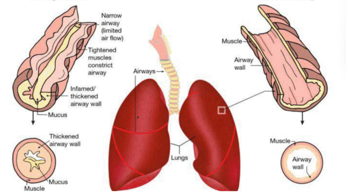 Important Traditional remedy for asthma, bronchitis, cough and lung diseases Important Traditional remedy for asthma, bronchitis, cough and lung diseases