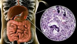 Cancer Of The Intestine Kills Fast: Avoid Too Much Intake Of Following 3 Things If You Want To Live Long