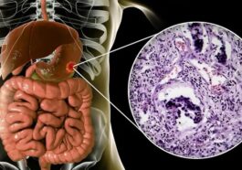 Cancer Of The Intestine Kills Fast: Avoid Too Much Intake Of Following 3 Things If You Want To Live Long