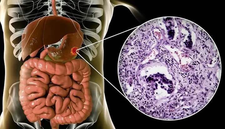 Cancer Of The Intestine Kills Fast: Avoid Too Much Intake Of Following 3 Things If You Want To Live Long Cancer Of The Intestine Kills Fast: Avoid Too Much Intake Of Following 3 Things If You Want To Live Long