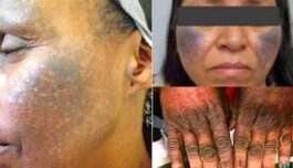 Skin Bleaching Creams & Pills Can Damage Your Kidney & Liver Permanently! (DETAILS)