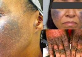 Skin Bleaching Creams & Pills Can Damage Your Kidney & Liver Permanently! (DETAILS)