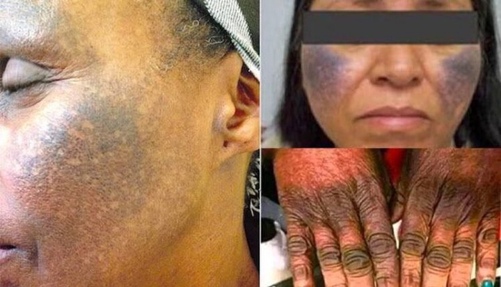 Skin Bleaching Creams & Pills Can Damage Your Kidney & Liver Permanently! (DETAILS) Skin Bleaching Creams & Pills Can Damage Your Kidney & Liver Permanently! (DETAILS)