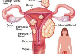 Conditions That May Affect a Woman’s Womb and Lead to Infertility (BREAKING)