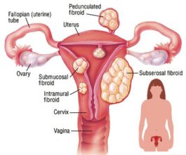 Conditions That May Affect a Woman’s Womb and Lead to Infertility (BREAKING)