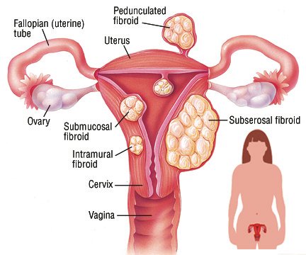 Conditions That May Affect a Woman’s Womb and Lead to Infertility (BREAKING)