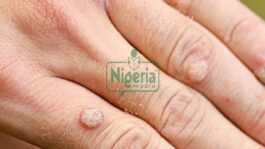 BREAKING NEWS: What These Little Bumps On The Skin Are And How To Take Care Of Them