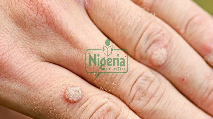 BREAKING NEWS: What These Little Bumps On The Skin Are And How To Take Care Of Them