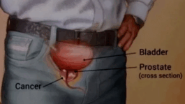 BREAKING NEWS: Dear Men Early Warning Signs Of An Enlarged Prostate That You Must Know If You Don’t Want To Suffer At Old Age