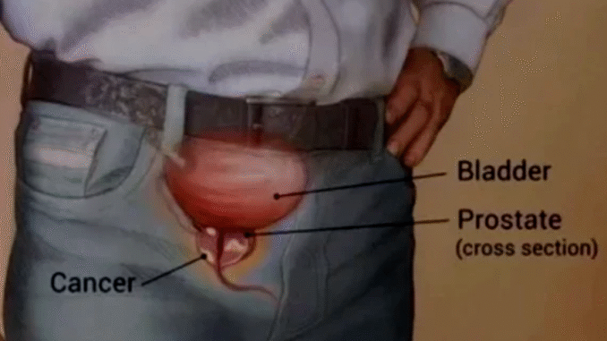 BREAKING NEWS: Dear Men Early Warning Signs Of An Enlarged Prostate That You Must Know If You Don’t Want To Suffer At Old Age