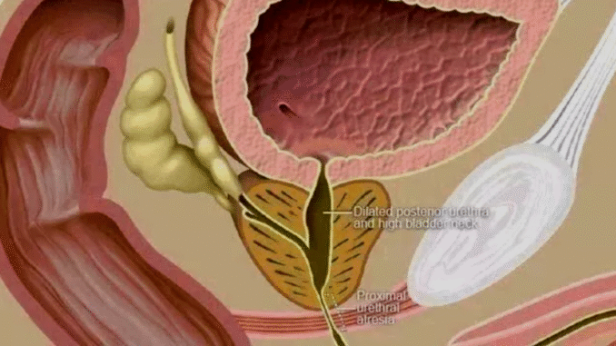 BREAKING: Urine Blockage Kills: Avoid These 5 Habits to Prevent Urine Blockages