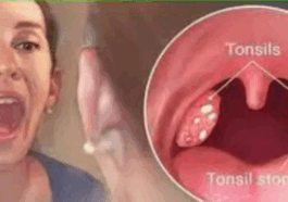 BREAKING: How to cure tonsillitis in 4 hours, fast and easy