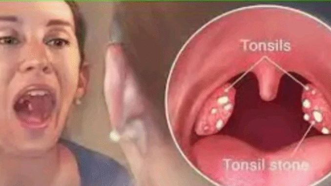 BREAKING: How to cure tonsillitis in 4 hours, fast and easy