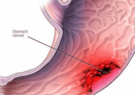 Cancer Of The Stomach Kills, Stop Eating These 3 Things. If you Want To Live Long