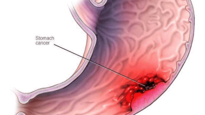 Cancer Of The Stomach Kills, Stop Eating These 3 Things. If you Want To Live Long Cancer Of The Stomach Kills, Stop Eating These 3 Things. If you Want To Live Long